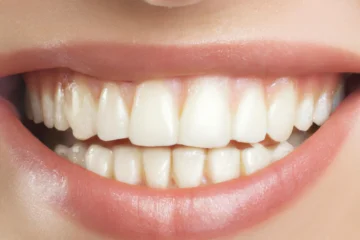 Correction du Sourire Gingival