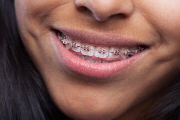 Brackets métalliques
