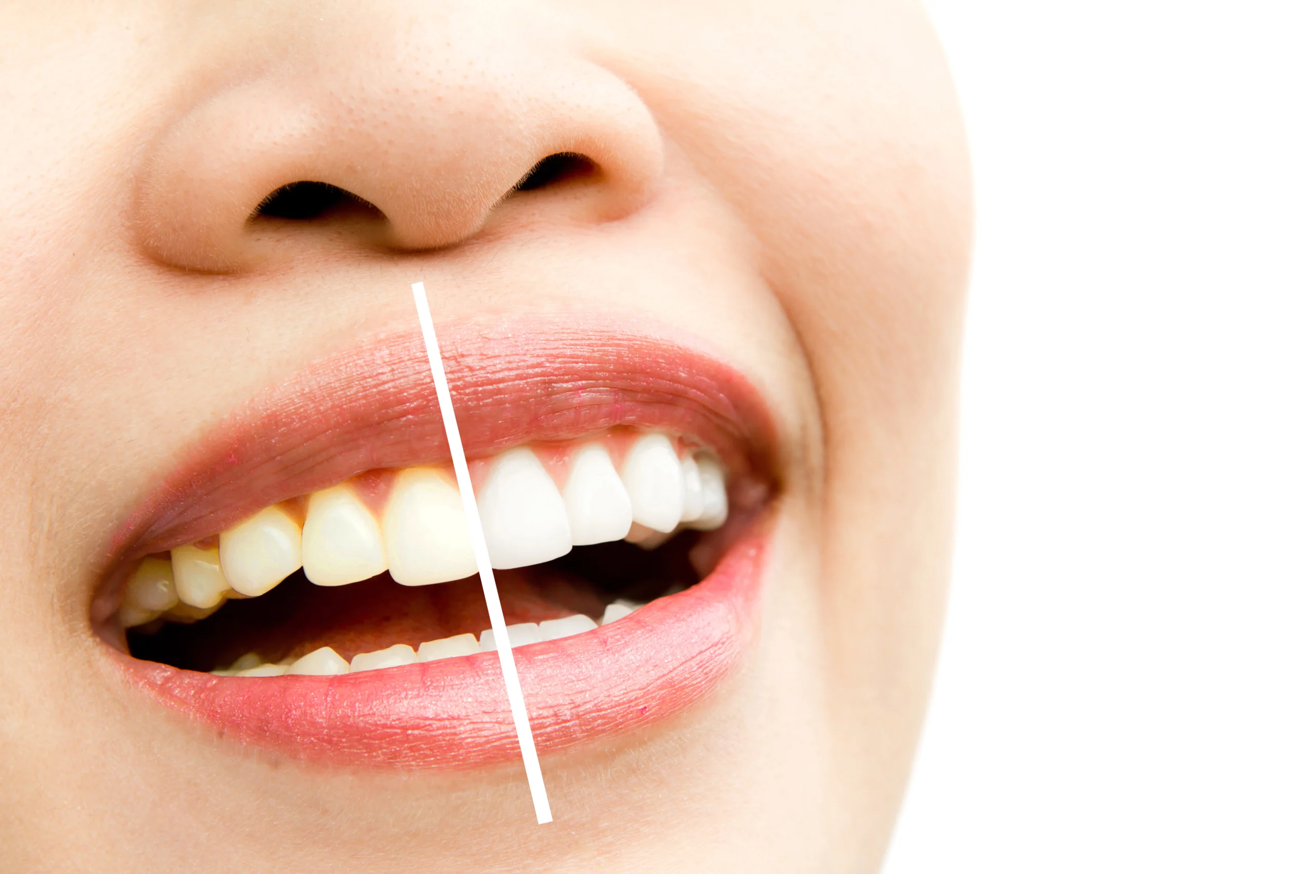 Blanchiment des dents
